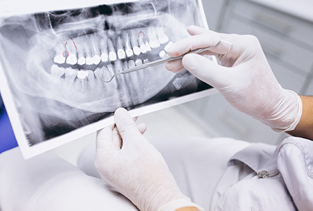 Endodoncia